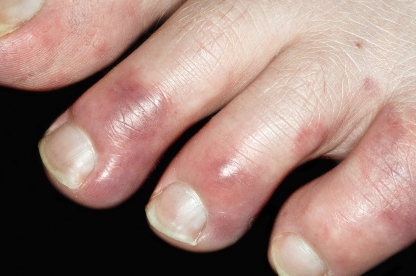 Chilblains – How To Prevent Yourself In Winter