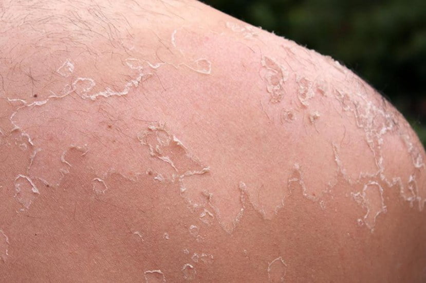 How To Stop Peeling From Sunburn