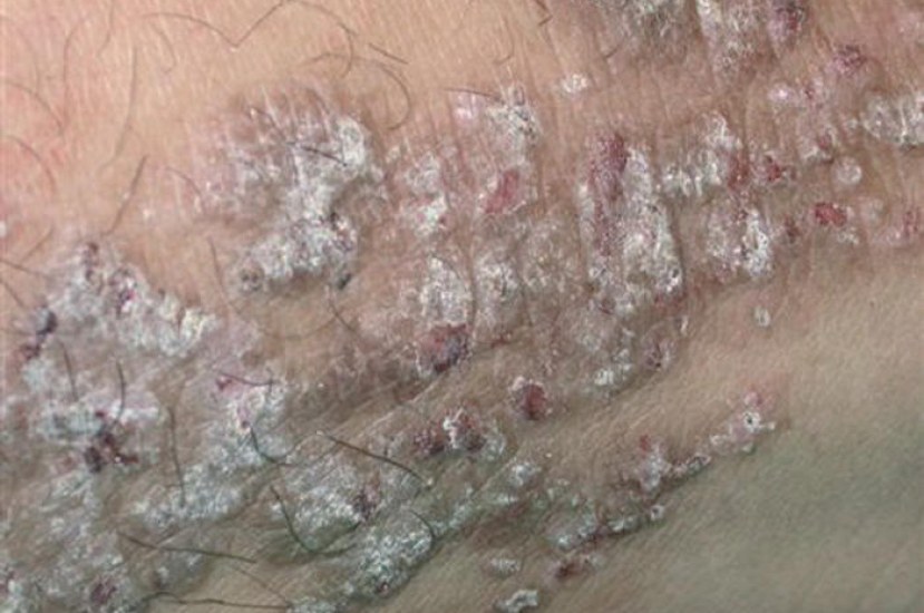 Hypertrophic lichen planus