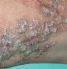 Hypertrophic lichen planus