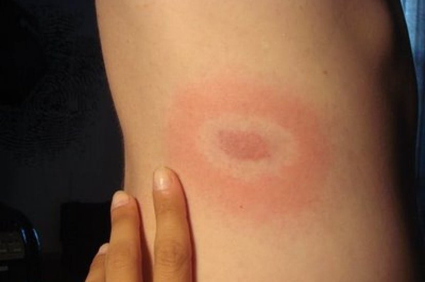 Bull’s eye Lyme disease rash