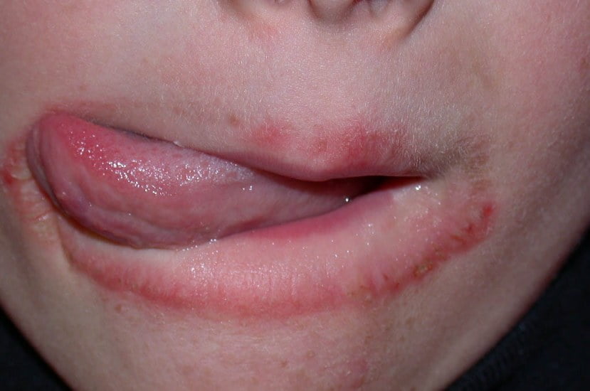 Lip Licker’s Dermatitis-A Common Problem During Winter