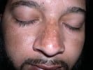 melasma on nose