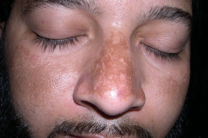 melasma on nose