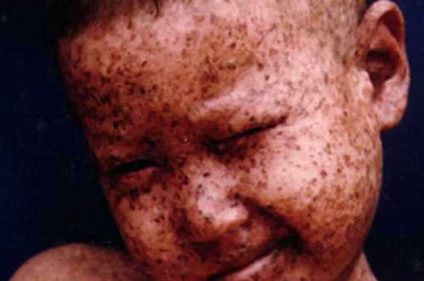 Xeroderma pigmentosum