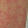 Erythema ab igne