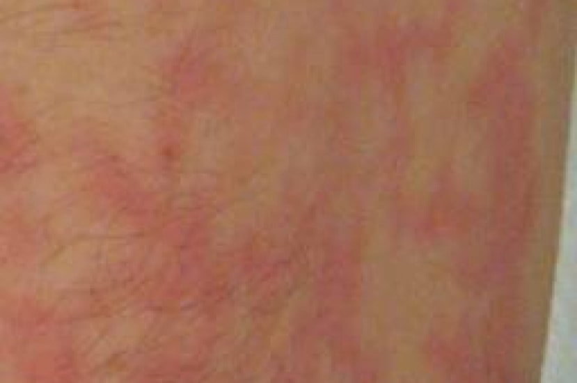 Erythema ab igne