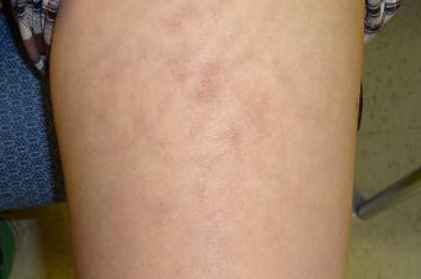 erythema ab igne