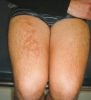 erythema ab igne thigh