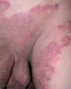 Tinea Cruris