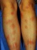 erythema nodosum