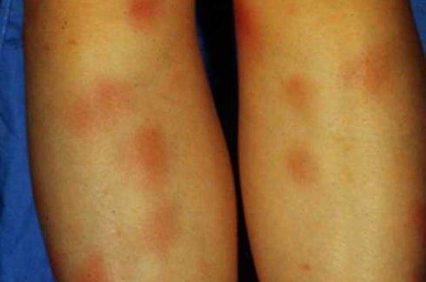 erythema-nodosum