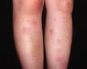 erythema nodosum