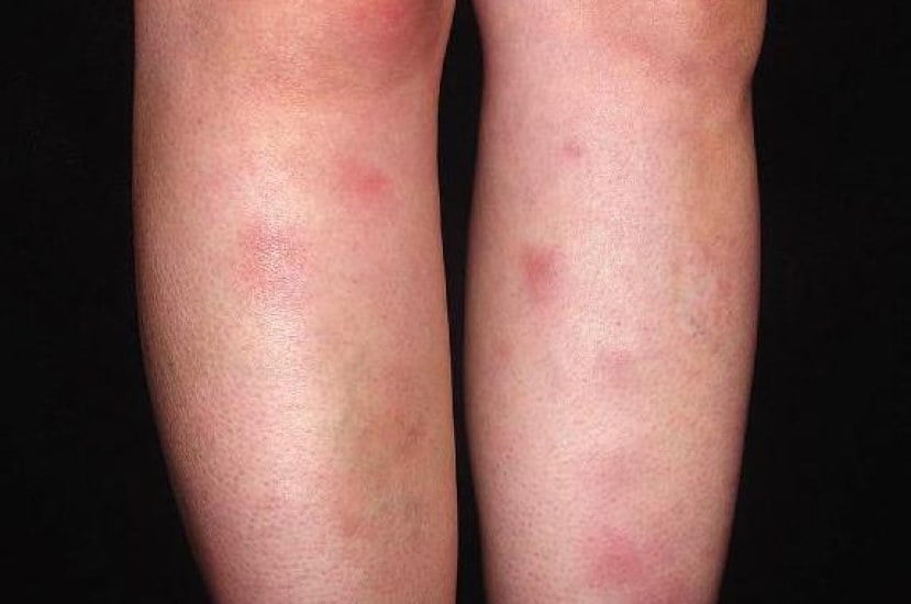 erythema-nodosum