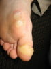 friction blisters