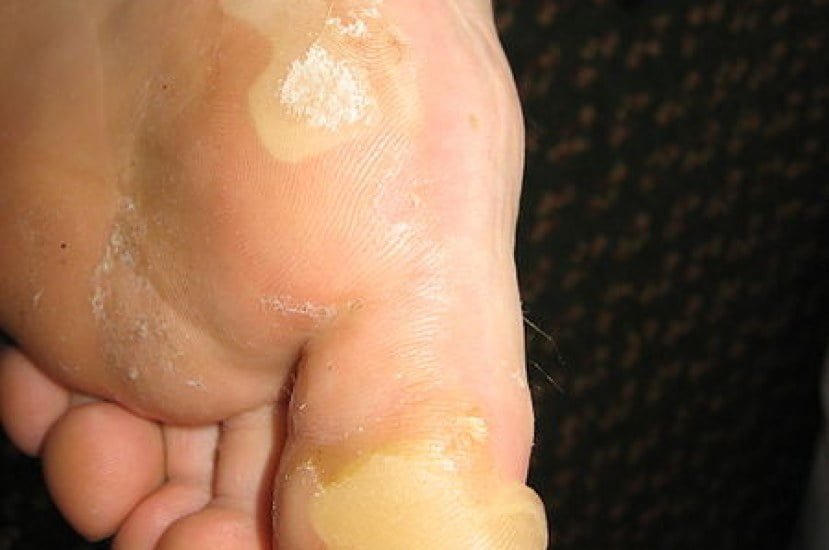 friction blisters on foot