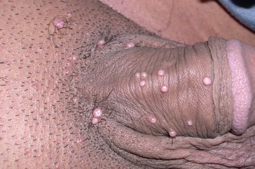 Molluscum Contagiosum on Penis