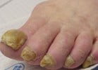 Onychomycosis