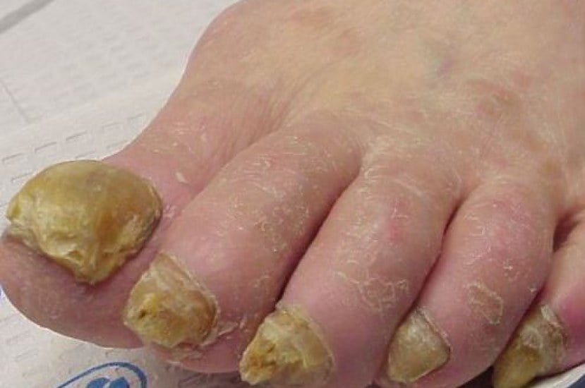 Onychomycosis-toenail fungal infection