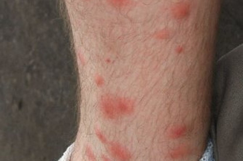 chiggers bite