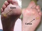 corn and callus