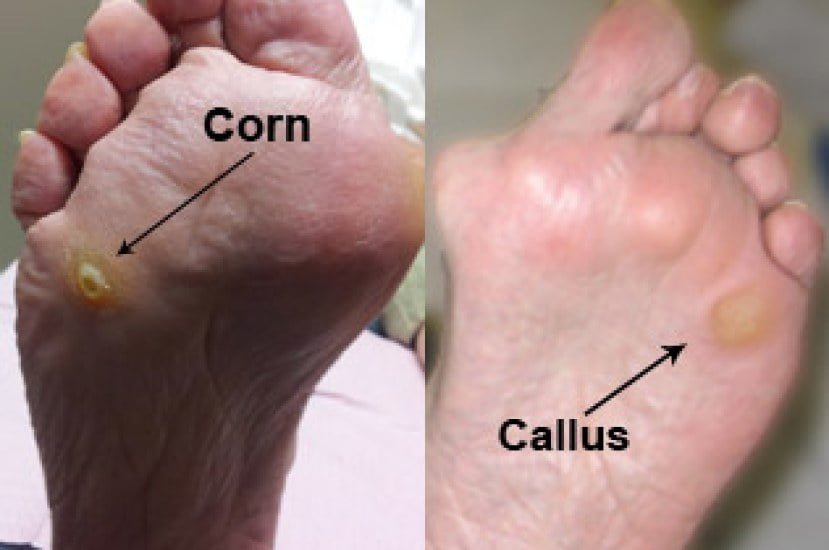 corn and callus on foot