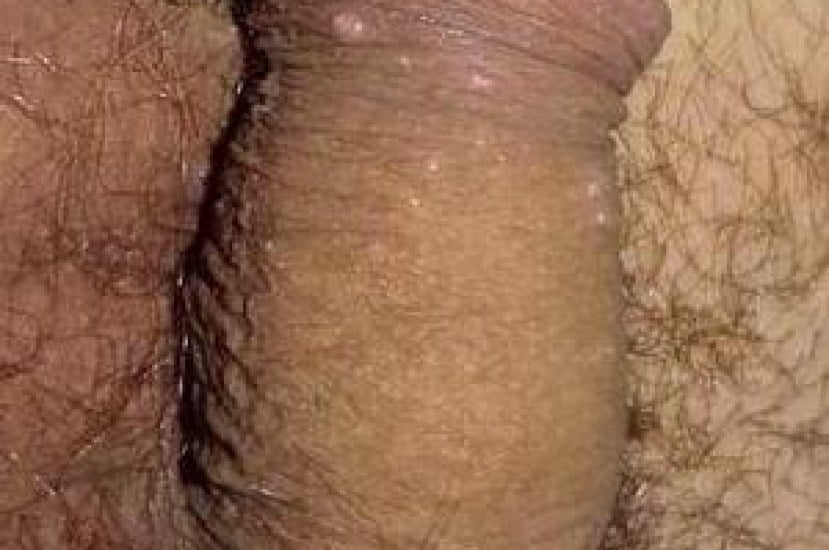 Molluscum Contagiosum on Penis