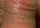 Molluscum Contagiosum on Penis