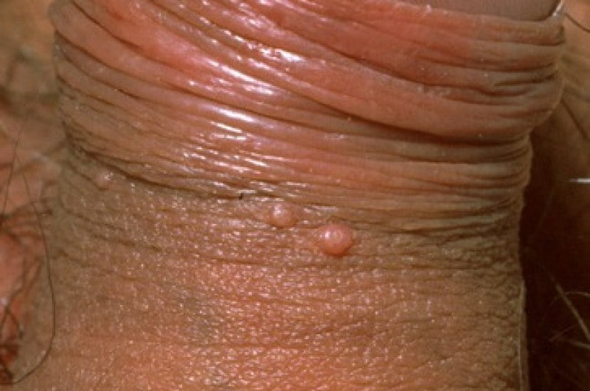 Molluscum Contagiosum on Penis