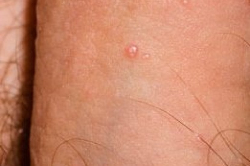 Molluscum Contagiosum on Penis