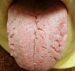 Fissured Tongue