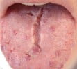 Fissured Cracked Tongue