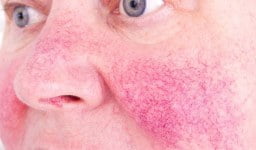 Minocycline Topical Foam 1.5% Approved by FDA for Rosacea
