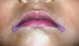 Rash in Corner of Mouth: Angular Cheilitis and its Treatment