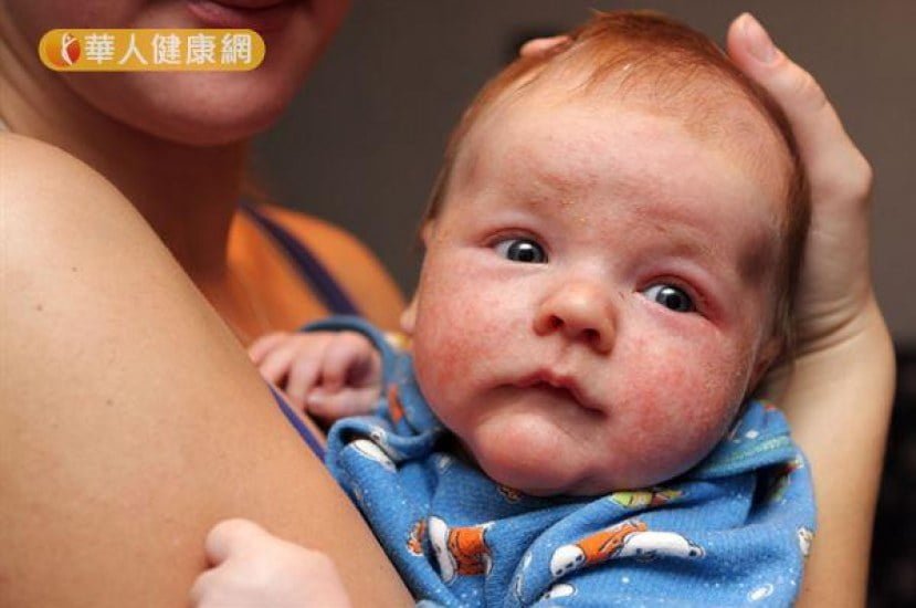 Heat rash in Babies: Best ways to Treat and Prevent