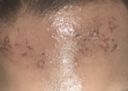 I Burnt Myself Using 70% lactic acid peel, how bad is it and what can I do?