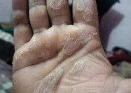 have had psoriasis on both of my hands