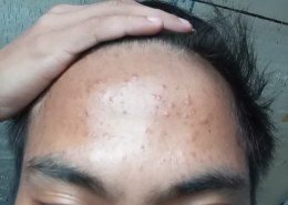 Acne problem