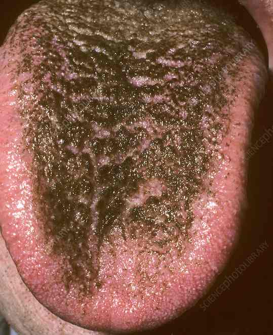 Black Hairy Tongue: Causes, Symptoms, Treatment & When to Worry