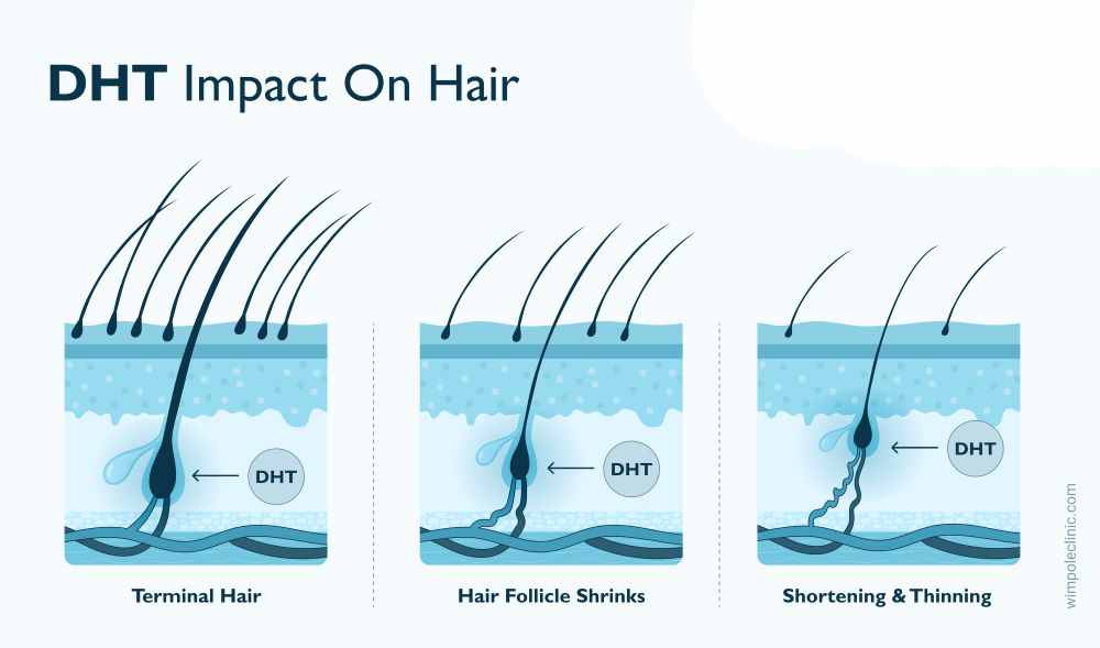 Hair Loss and Hormones: Understanding Testosterone, Dihydrotestosterone (DHT), and Androgens in Hair Loss