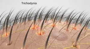 Trichodynia