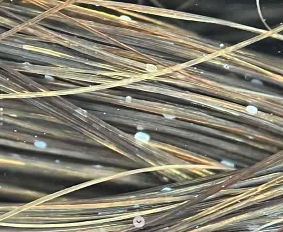 Piedra Hair Infection: White Piedra vs Black Piedra – Causes, Symptoms & Treatment