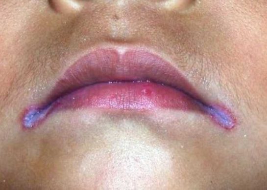 Rash in the Corner of the Mouth: Angular Cheilitis Causes, Symptoms & Fast Treatment