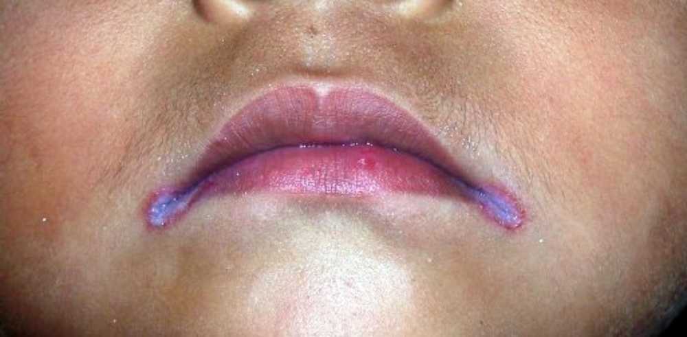 Rash in the Corner of the Mouth: Angular Cheilitis Causes, Symptoms & Fast Treatment
