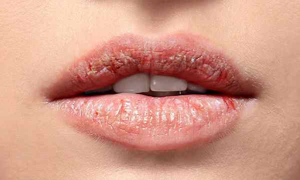 Chapped Lips in Winter: Causes, Best Treatments & Prevention Tips