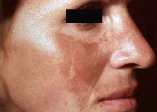 Essential Vitamins for Melasma: What Your Skin Really Needs