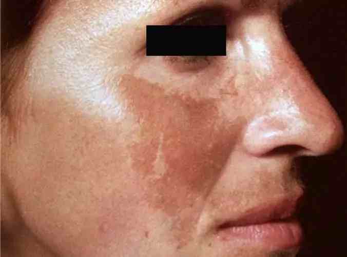 Essential Vitamins for Melasma: What Your Skin Really Needs