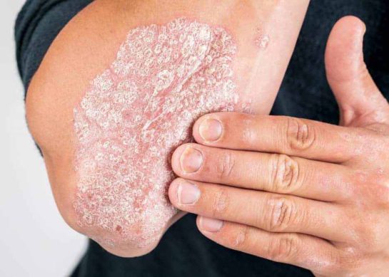 Psoriasis Winter Treatment: How to Control Flare-Ups in Cold Weather