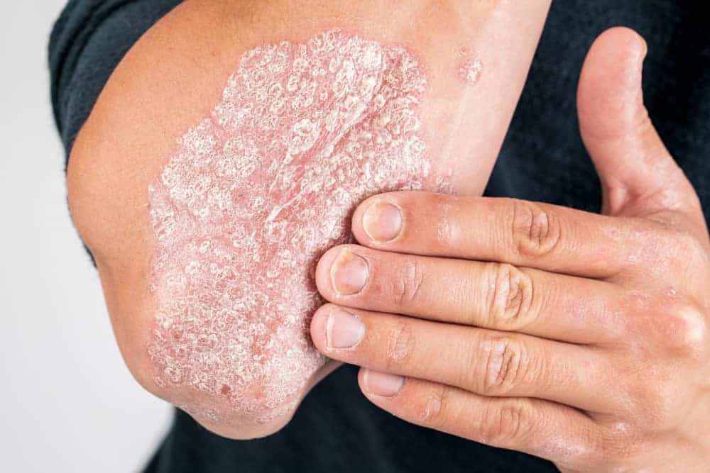 Psoriasis Winter Treatment: How to Control Flare-Ups in Cold Weather